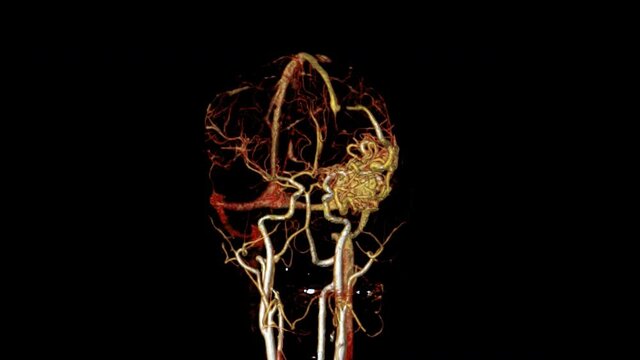 CTA Brain or computed tomography angiography of the brain 3D rendering image showing Brain AVM or arteriovenous malformation turn around on the screen.