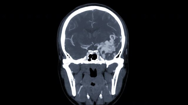 CTA Brain or computed tomography angiography of the brain Coronal MIP image showing Brain AVM or arteriovenous malformation turn around on the screen.