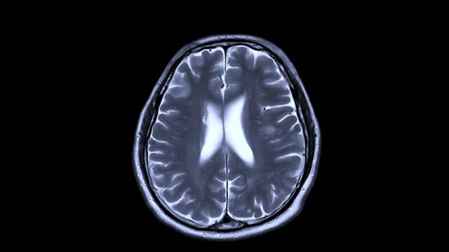Compare  MRI brain axial T2 ,T1 and T2 flair techinque for detect a variety of bleeding and stroke disease.
