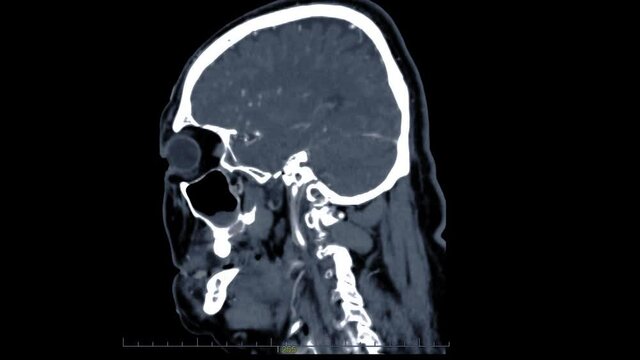  CTA brain Sagittal MIP view after injection contrast media agent for detect cerebral artery aneurysm