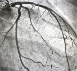 Normal coronary angiogram of left coronary artery during cardiac catheterization.