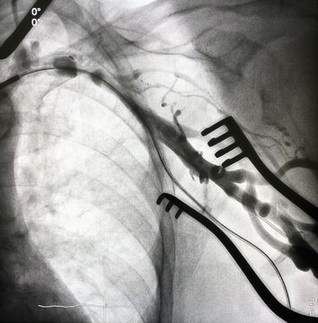 X ray image during permanent pacemaker implantation procedure.