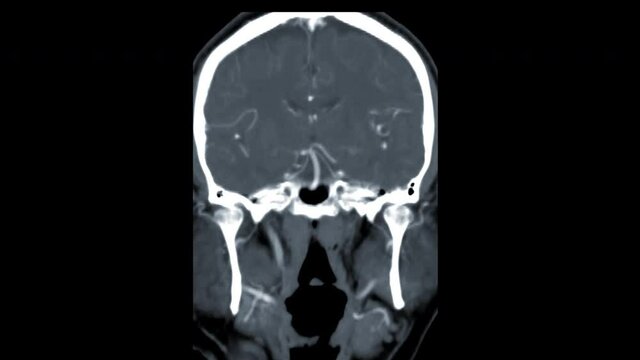  CTA brain Coronal MIP view after injection contrast media agent for detect cerebral artery aneurysm