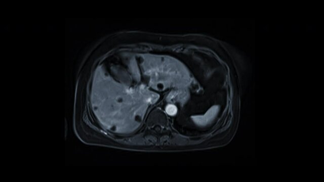 MRI UPPER Abdomen Axial T2W view for investigate the cause of pain or HCC .