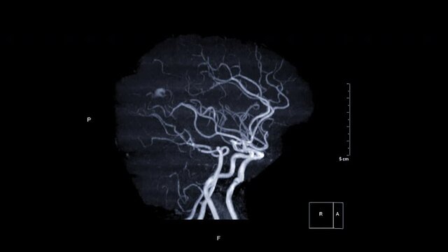 MRA Brain or Magnetic resonance angiography of Cerebral artery in the brain MIP technique  turn around on the screen for evaluate cerebral artery aneurysms or stenosis . 