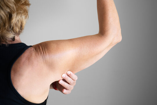 Older Woman Cosmetic Liposuction Surgery