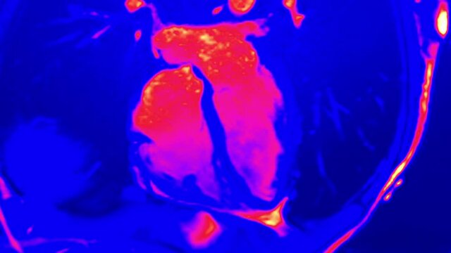 Cardiac MRI of Beating Heart, Multicolor Spectrum Look