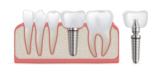 Dental implant. Teeth care surgery and crown fixture. Tooth replacement and prosthesis treatment. Implantation of artificial molar with metal screw. Denture model. Vector stomatology
