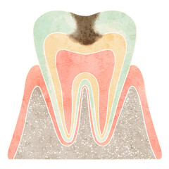 虫歯になった歯の断面（C2）