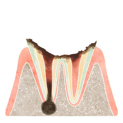 虫歯になった歯の断面（C4） - obrazy, fototapety, plakaty
