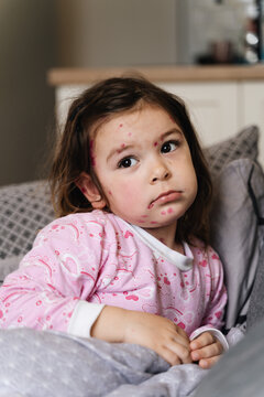 Toddler girl with chickenpox measles on the body. Varicella virus childhood contagious disease. Itchy red blisters, fever, pain symptoms. 