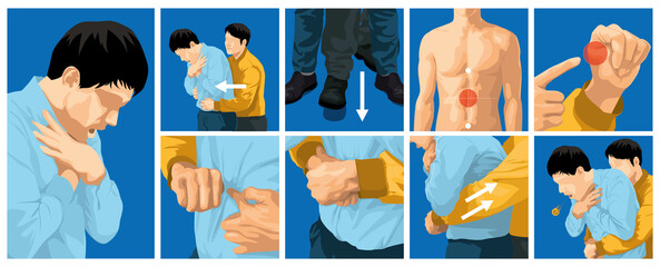 Heimlich maneuver vector illustration. first aid to choking for adults. - obrazy, fototapety, plakaty