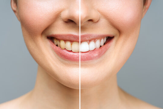 woman teeth before and after whitening. Over white background. Dental clinic patient. Image symbolizes oral care dentistry, stomatology.