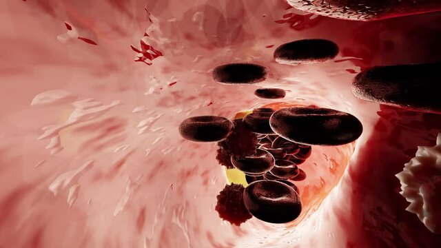 Vascular occlusion is a blockage of a blood vessel, usually with a clot. 3d render. heart attack