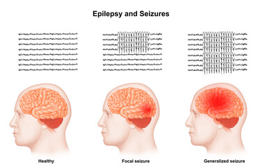 Epilepsy and Seizures - obrazy, fototapety, plakaty