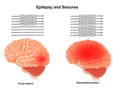   Brain focal Seizures