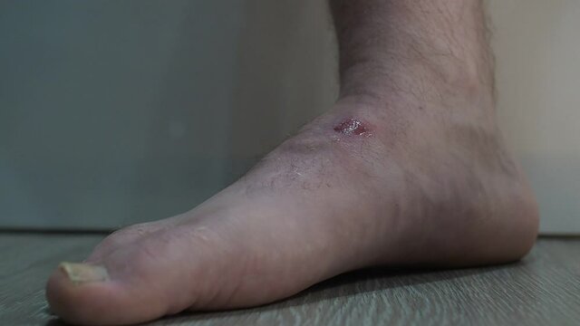 the man abruptly removes the Band-Aid from the wound on the hairy leg
