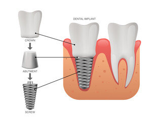 Dental implant structure, human teeth and dental implant, vector illustration