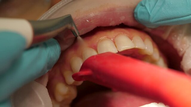 Hygienist or Dentist cleaning teeth with spray, air water syringe tool, close up