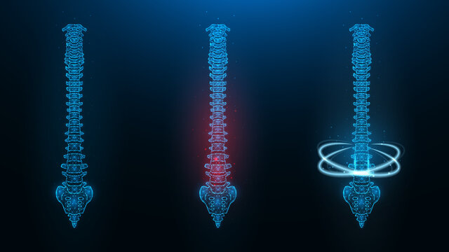 Polygonal vector illustration of a human spine. Image of a healthy, sick and recovering spine.