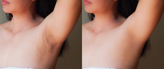 Image before and after skincare cosmetology armpits epilation treatment concept.Problem underarm chicken skin,Fox Fordyce,Black armpit in woman. - obrazy, fototapety, plakaty
