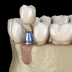 Augmentation Surgery - Adding new bone. 3D illustration