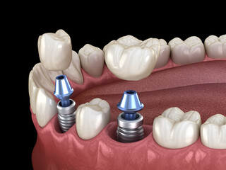 Premolar and Molar tooth crown installation over implant. 3D illustration of human teeth and dentures