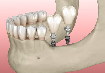 Implantation with mini implants in to recessed jaw bone: Medically accurate 3D illustration - obrazy, fototapety, plakaty