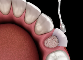 Augmentation Surgery - Adding bone after tooth extraction. 3D illustration