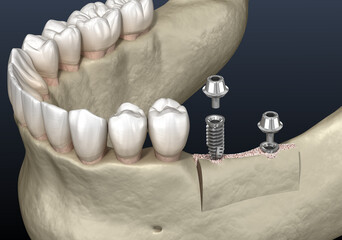 Cleavage of the alveolar ridge : implantation. Dental surgery, 3D illustration