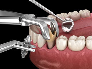 Extraction and Implantation, complex immediate surgery. Medically accurate 3D illustration of dental treatment - obrazy, fototapety, plakaty