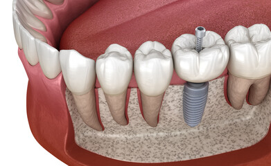 Molar tooth crown installation over implant abutment. Medically accurate 3D illustration of human teeth and dentures concept