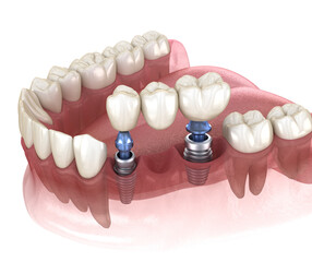 Dental bridge supported by implants. Medically accurate 3D illustration of human teeth and dentures concept - 434249794