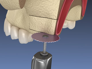 Sinus Lift Surgery - Creating side access to the Sinus. 3D illustration
