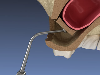 Sinus Lift Surgery - Moving sinus membrane. 3D illustration © Alex Mit