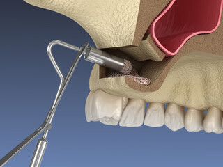 Sinus Lift Surgery - Adding artificial new bone. 3D illustration © Alex Mit