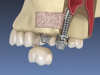 Sinus Lift Surgery - implant installation. 3D illustration © Alex Mit