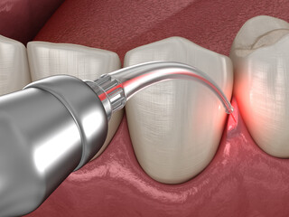 Gum correction surgery with laser.  Medically accurate tooth 3D illustration