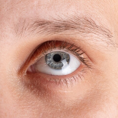 eye diagnosed with keratoconus closeup. 