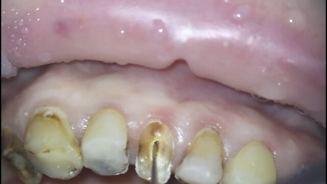 dentistry. shooting with a microscope. dental treatment. mechanical expansion of the root canal with an endomotor with a root file using a drill. drill