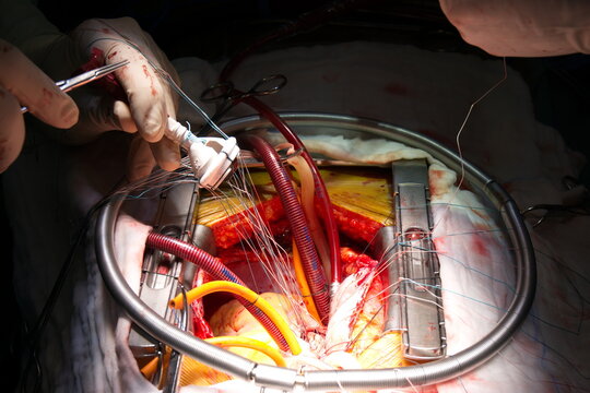 Mitral valve replacement (MVR) procedure with mechanical valve.