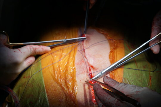 Suture median sternotomy wound after successful open heart surgery.