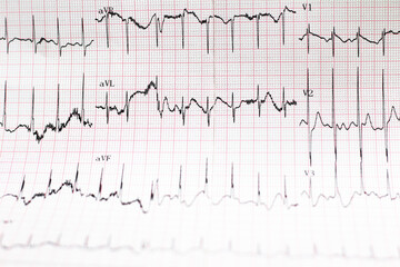 Electrocardiogram of wave in paper report analysis. Medical and healthcare concept.
