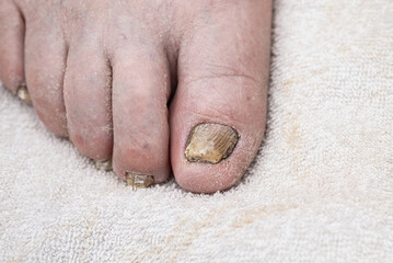 Fungus Infection on Nails of Man's Foot.White background,indoors image.