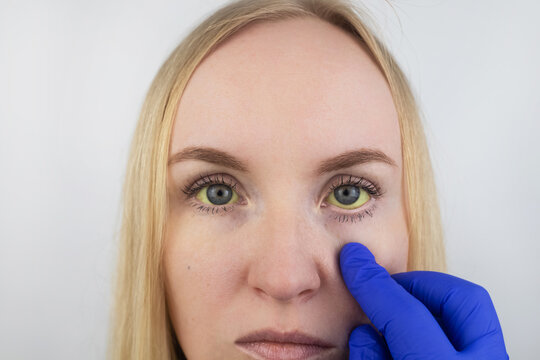 The yellow color of the woman eye. Symptom of jaundice, hepatitis or problems with the gall bladder, gastrointestinal tract, liver. Yellow eye in diseases of the liver, cirrhosis, hepatitis, bilirubin