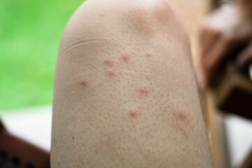 Naklejka premium Swollen blisters on the skin caused by mosquito bites at thigh