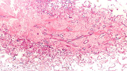 Fungal Infection - Mucormycosis: Broad, wide-angle non-septate hyphae of the fungus Mucor, from the paranasal sinus of a patient with uncontrolled diabetes mellitus.  Hematoxylin and Eosin (HE) stain - obrazy, fototapety, plakaty