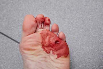 Laser removal of wart from the foot. Cut out verruca. Immediately after surgery. Blood flows from...