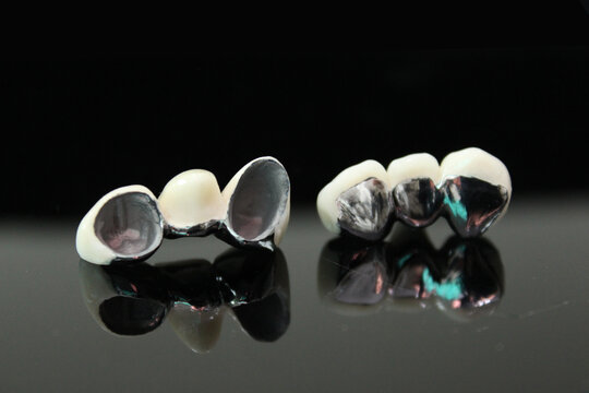 Porcelain fused to metal. PFM bridge