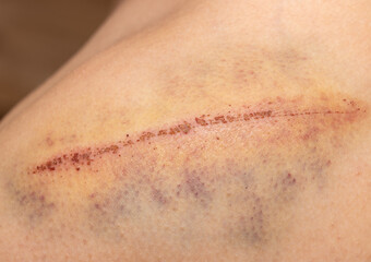 deep scratch with a bruise on the skin of the shoulder